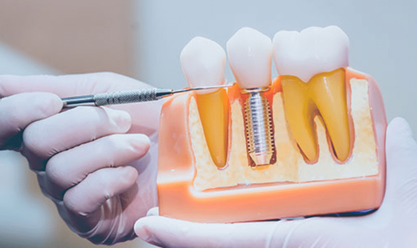 DENTAL IMPLANT CARE: 7 TIPS FOR LOOKING AFTER YOUR IMPLANTS