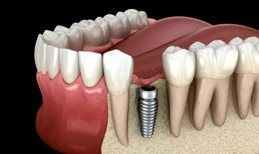 What Are Dental Implants and How Do They Work?