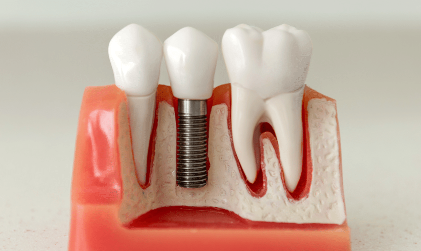 https://www.montgomerydentalloft.com/boost-confidence-the-impact-of-dental-implants/