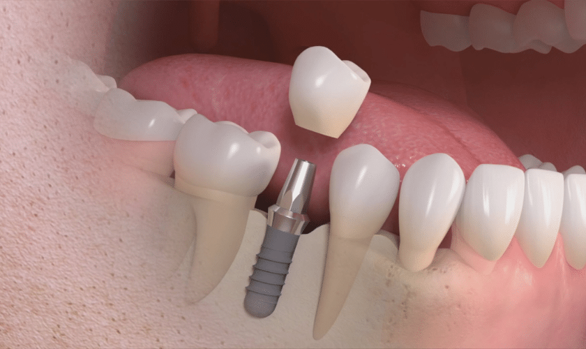 Understanding the Versatility of Dental Implants